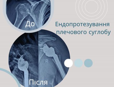 У Васильківській лікарні вперше виконали ендопротезування плечового суглоба